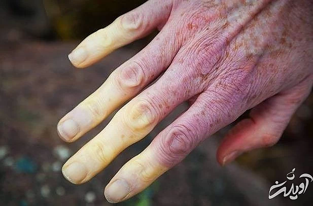 لوپوس از دلایل بی حسی و خواب رفتگی دست ها لوپوس